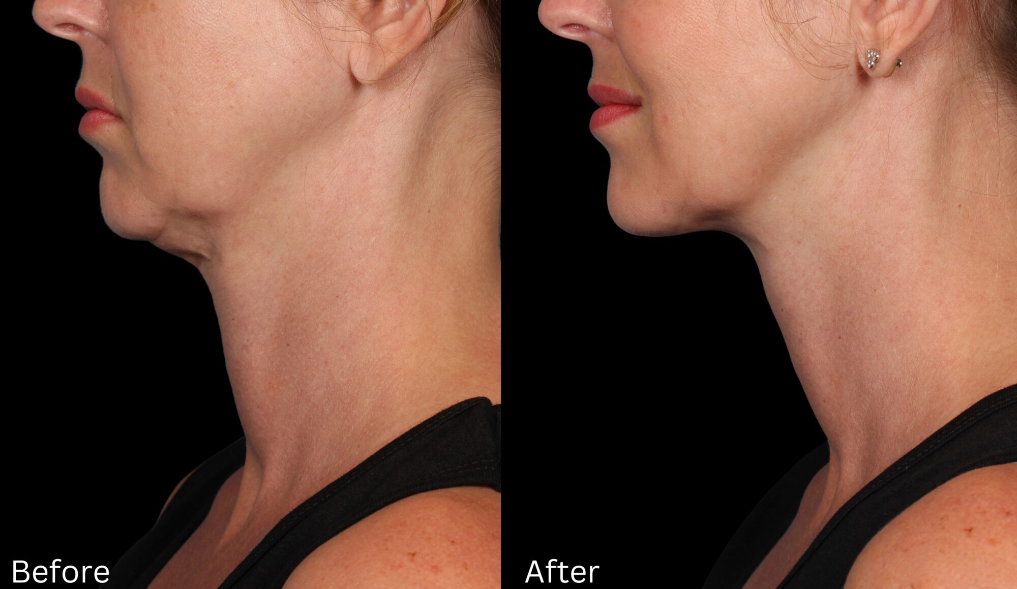 Kybella