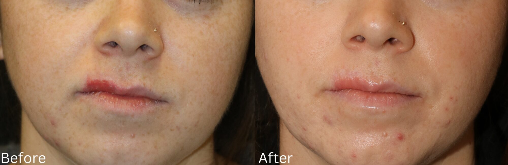 Scar Therapy