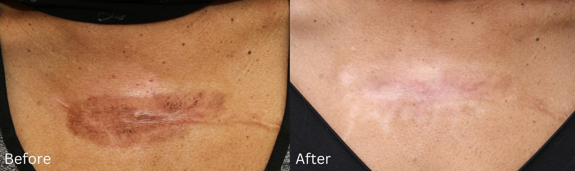 Website BAs - 256 Scar Therapy