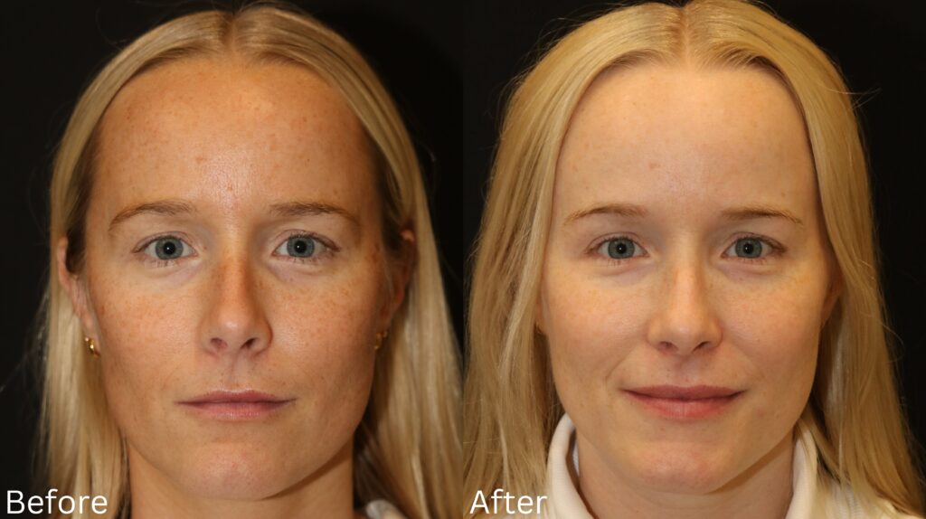 Sun Damage