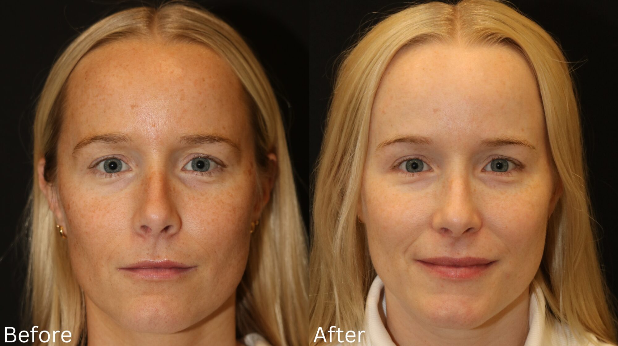Sun Damage