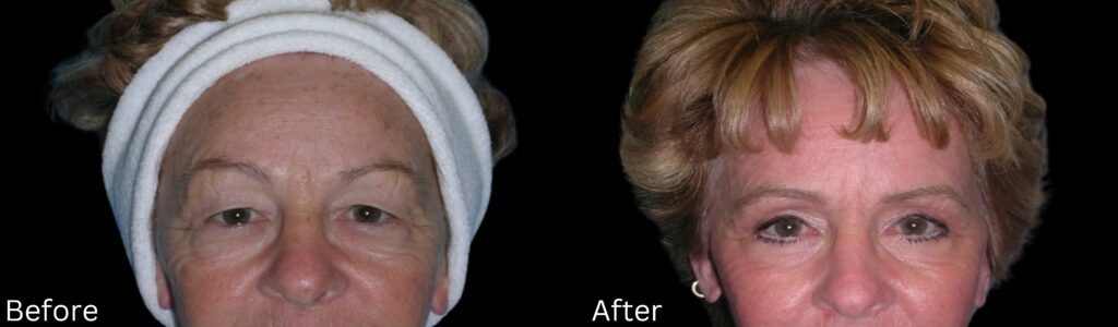 Eyelid Lift