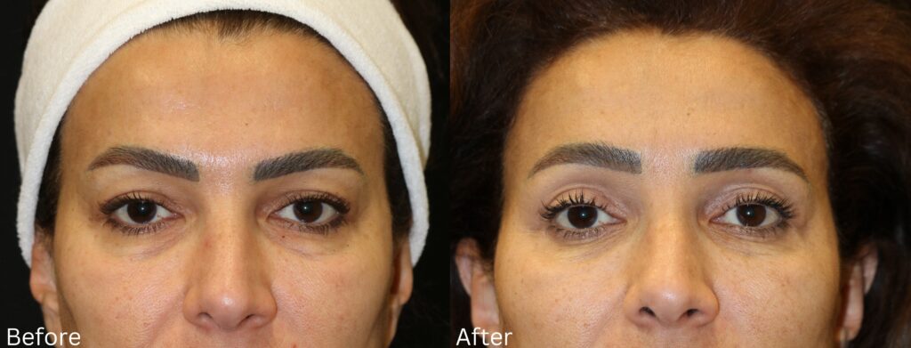 Eyelid Lift
