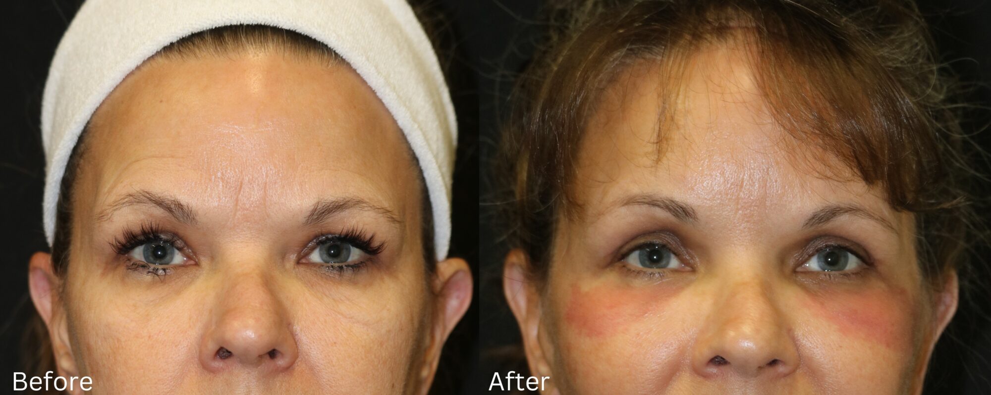 WebsiteBAs2 - 41 Eyelid Lift