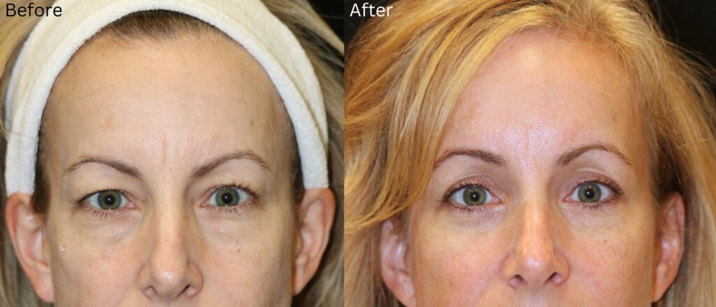 Eyelid Lift