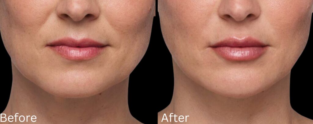 Juvederm Filler