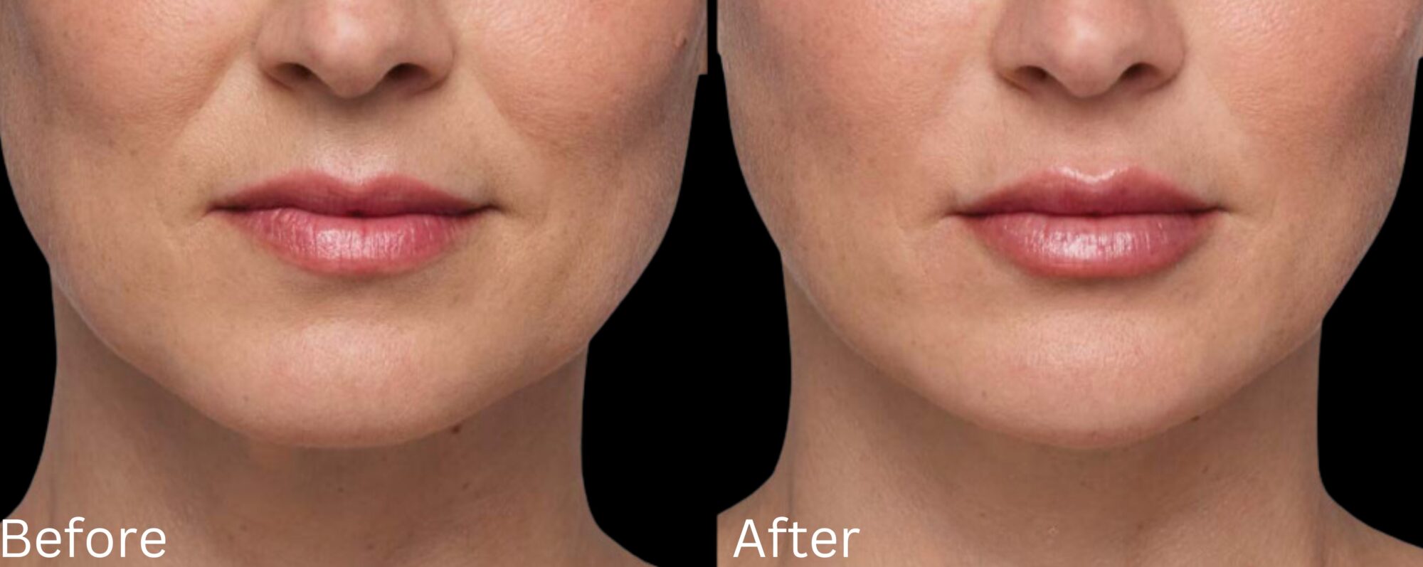 Juvederm Filler