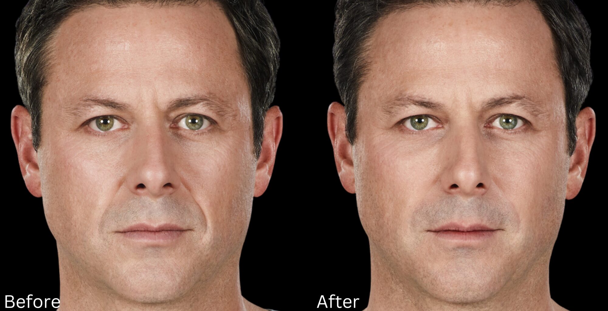 Juvederm Filler