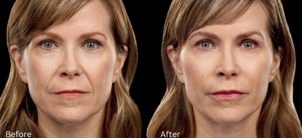 Juvederm Filler