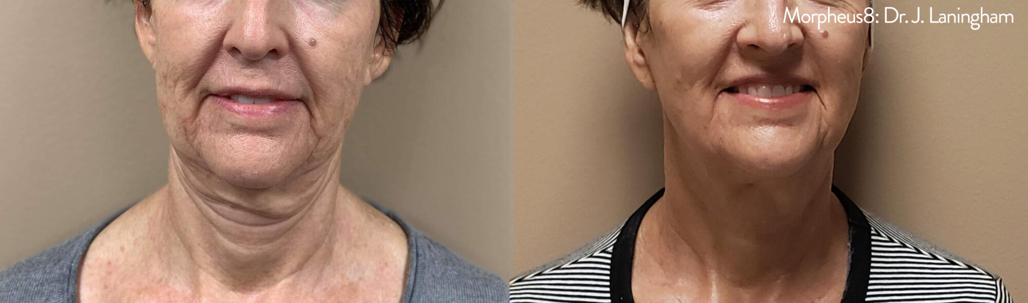 Skin Tightening