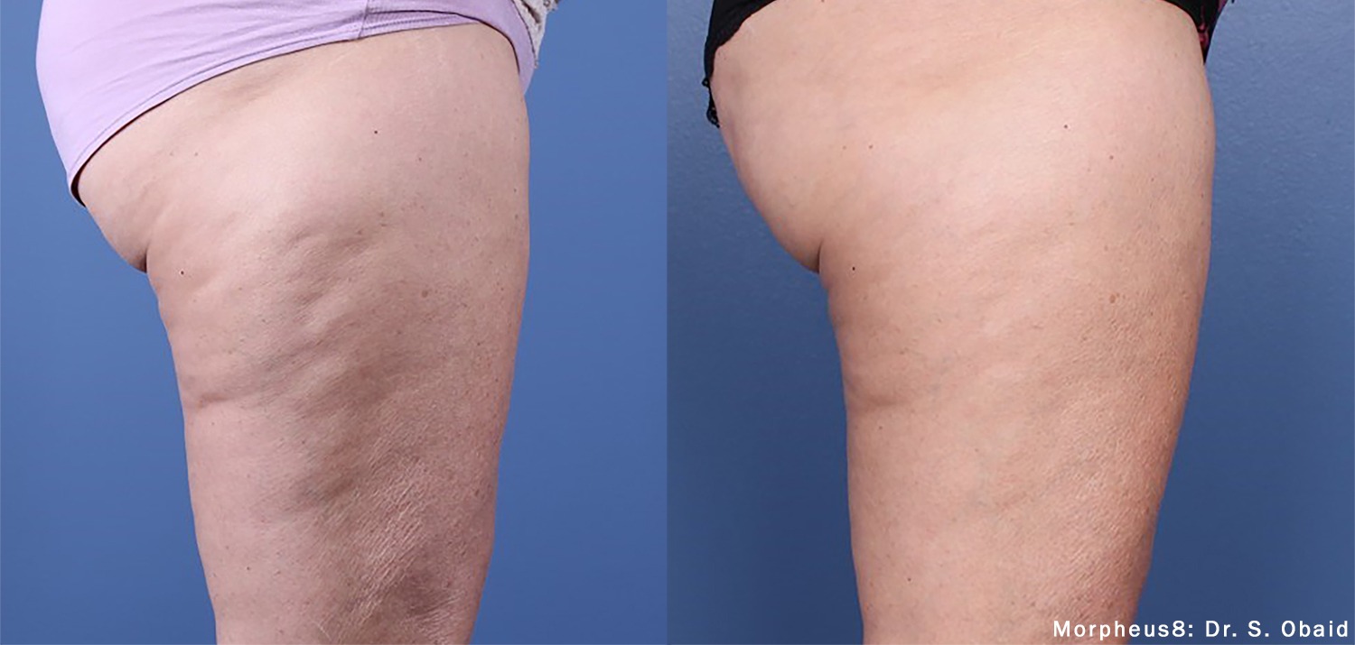 Skin Tightening