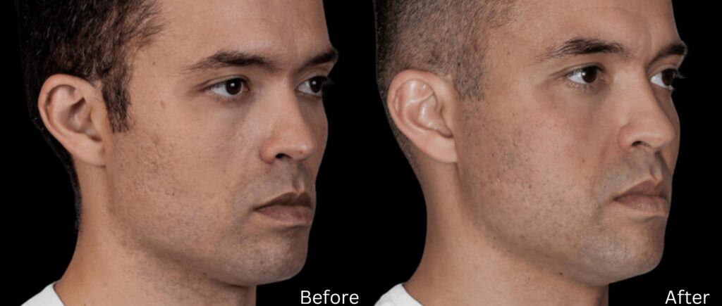 Sculptra