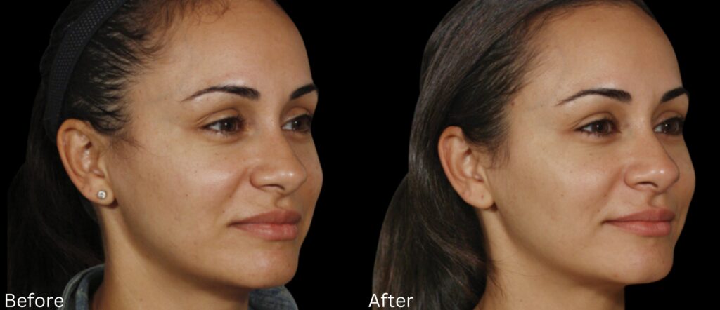 Sculptra