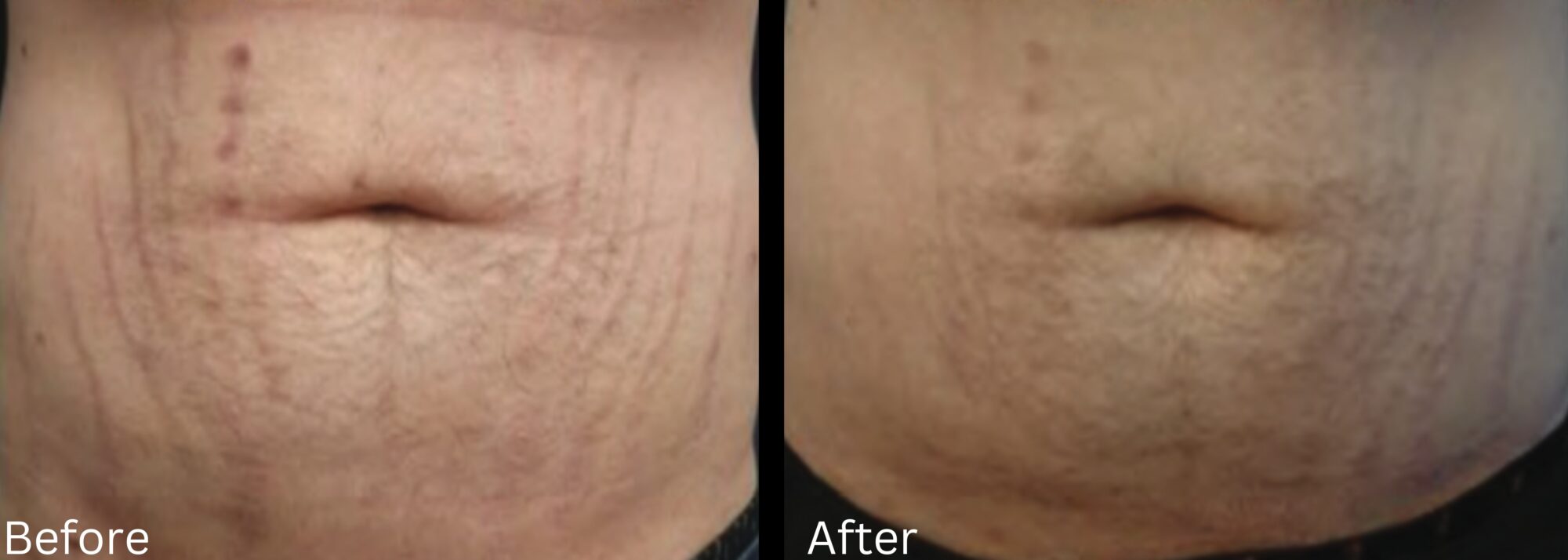 Stretch Marks