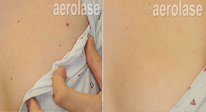 Veins Lesions