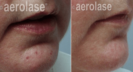 Veins Lesions