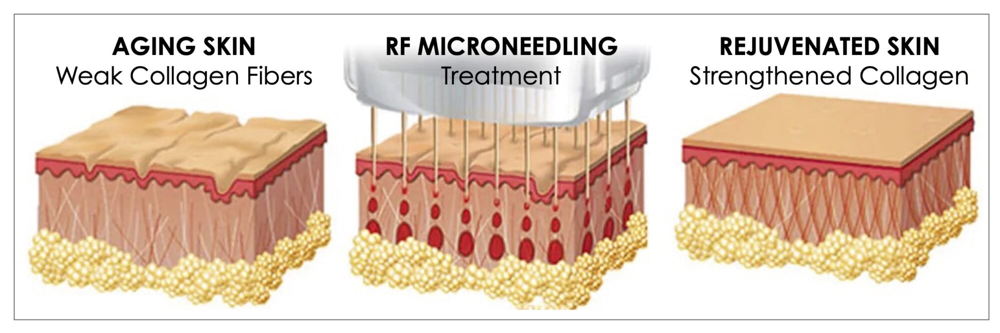 Morpheus8 RF Microneedling Chernoff Morpheus8 RF Microneedling Chernoff