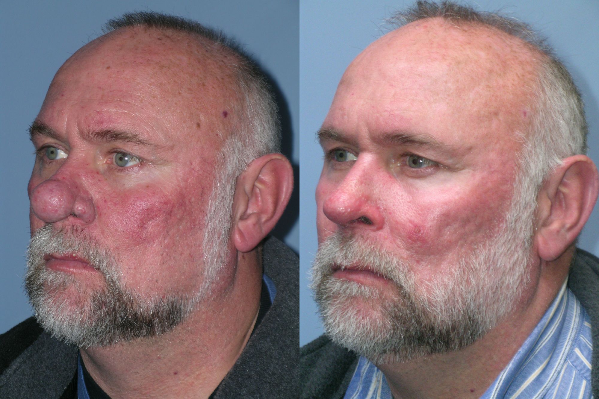 Rhinophyma ba 1