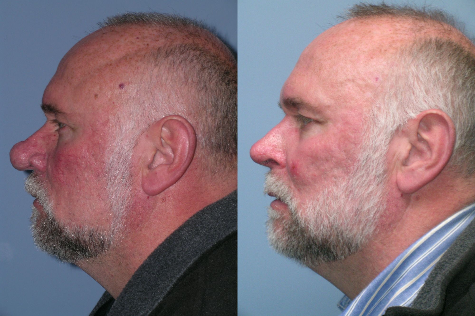 Rhinophyma ba 2