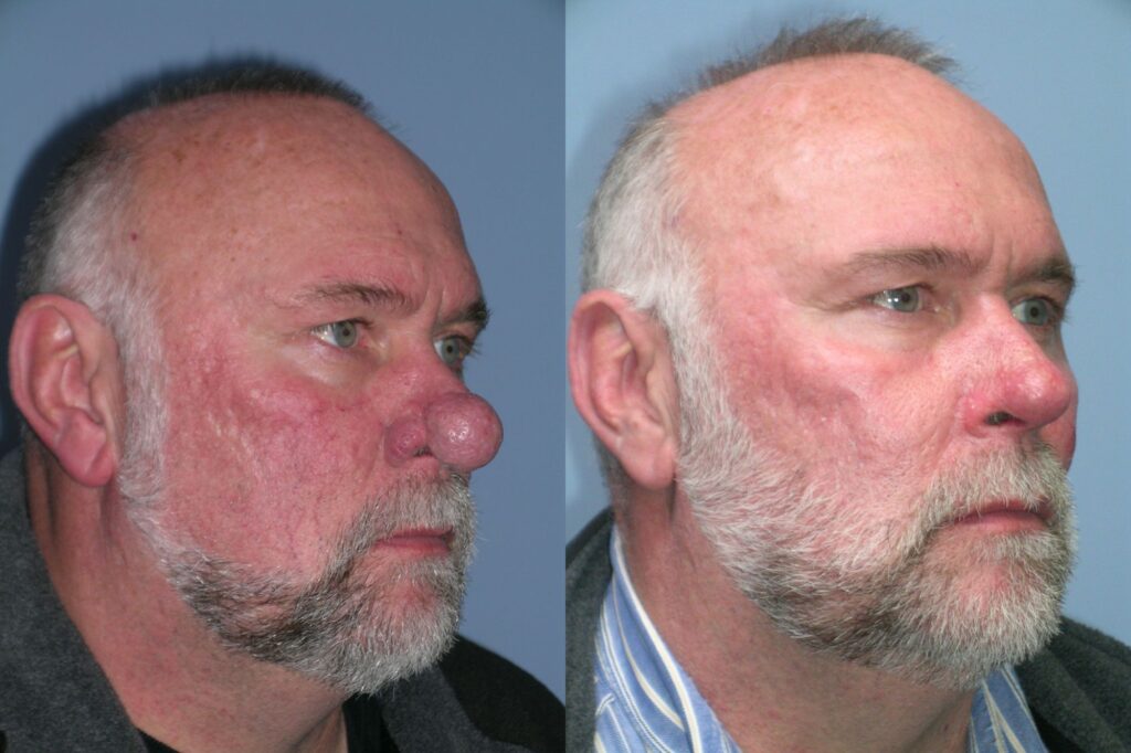 Rhinophyma
