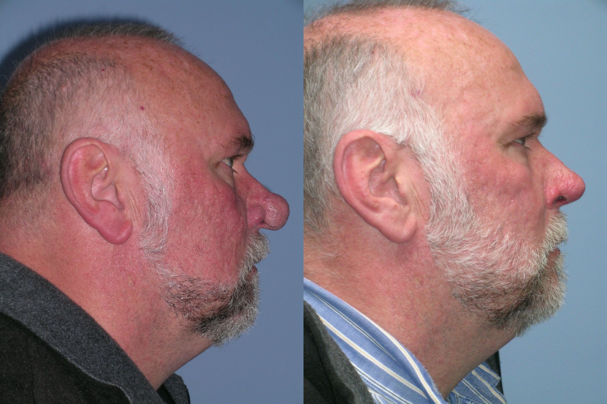 Rhinophyma ba 4