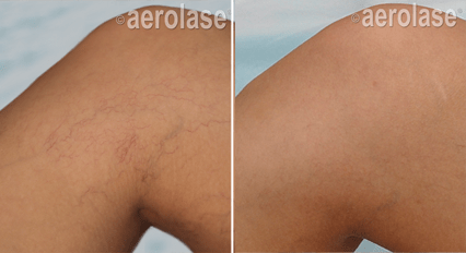 Veins & Lesions