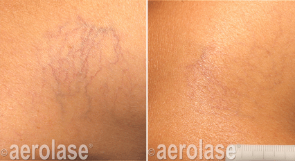 Veins Lesions