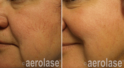 Veins Lesions