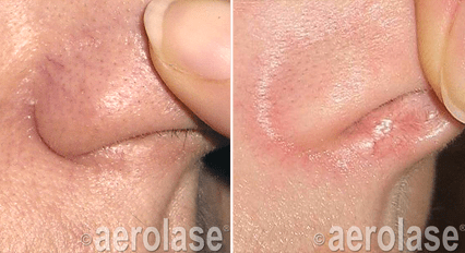 Veins Lesions