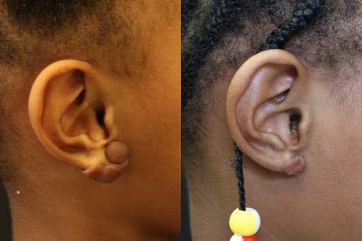 Keloid Removal