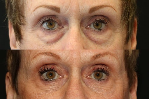 Eyelid Lift
