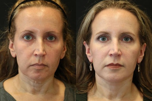 Face and Neck Lift