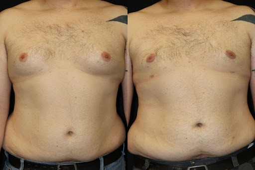 Gynecomastia