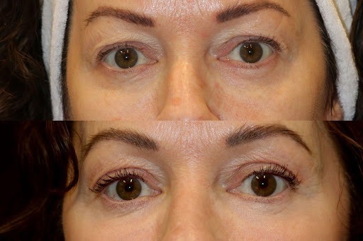 Eyelid Lift