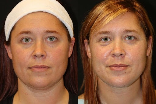 Face and Neck Lift