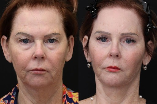 Facelift and Neck Lift + Eyelid Lift