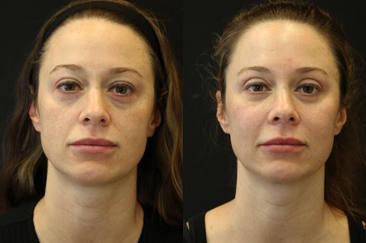 Eyelid Lift