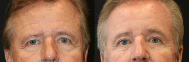 Eyelid Lift