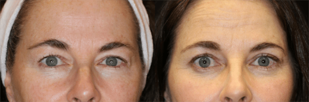 Eyelid Lift