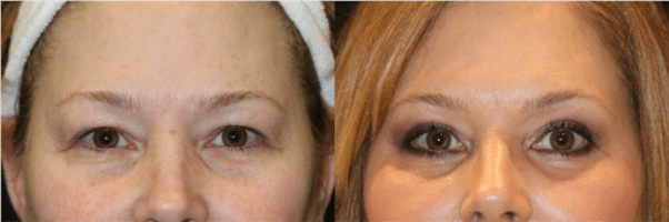 Eyelid Lift