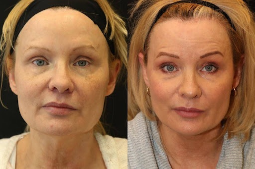 Face and Neck Lift