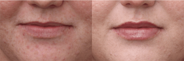 Lip Filler