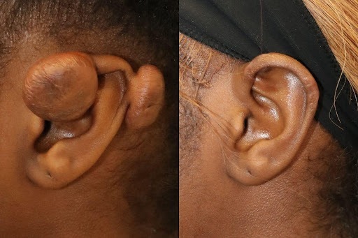 Keloid Removal