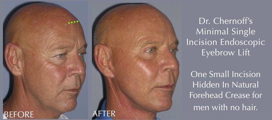 Endoscopic Eyebrow Lift DrChernoff Endoscopic Eyebrow Lift DrChernoff