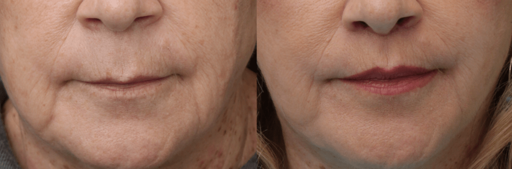 Lip Lift