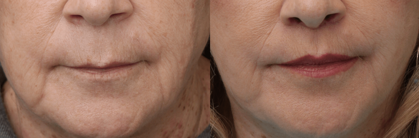Lip Lift