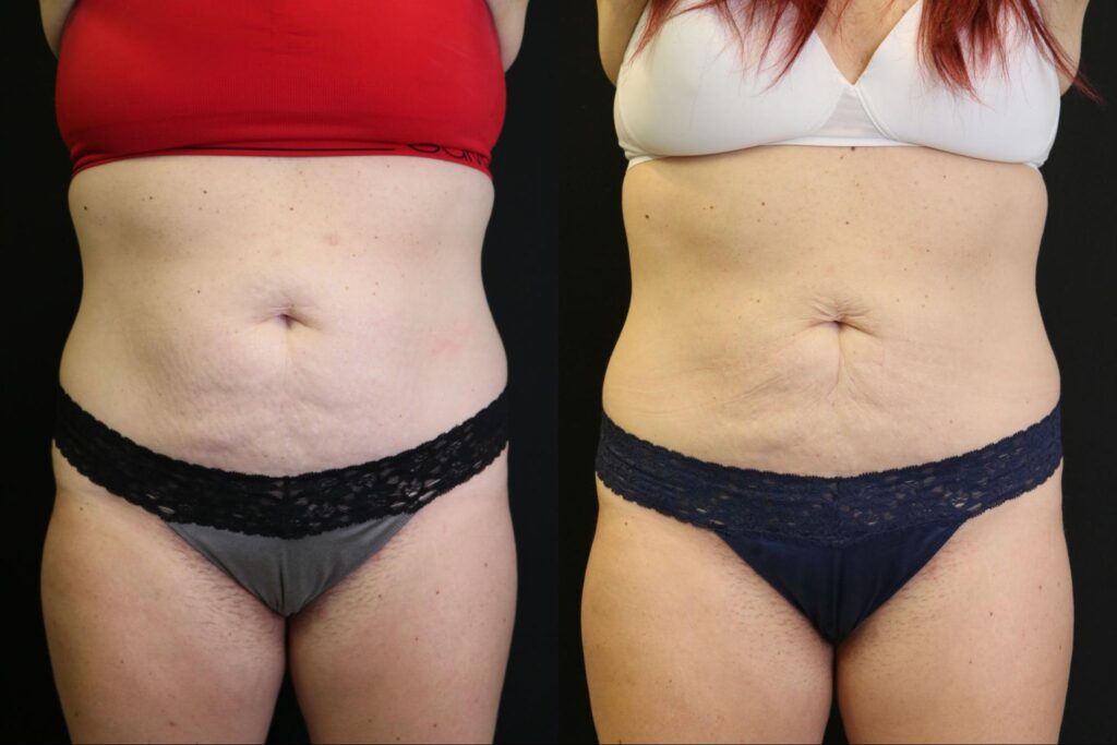 Coolsculpting