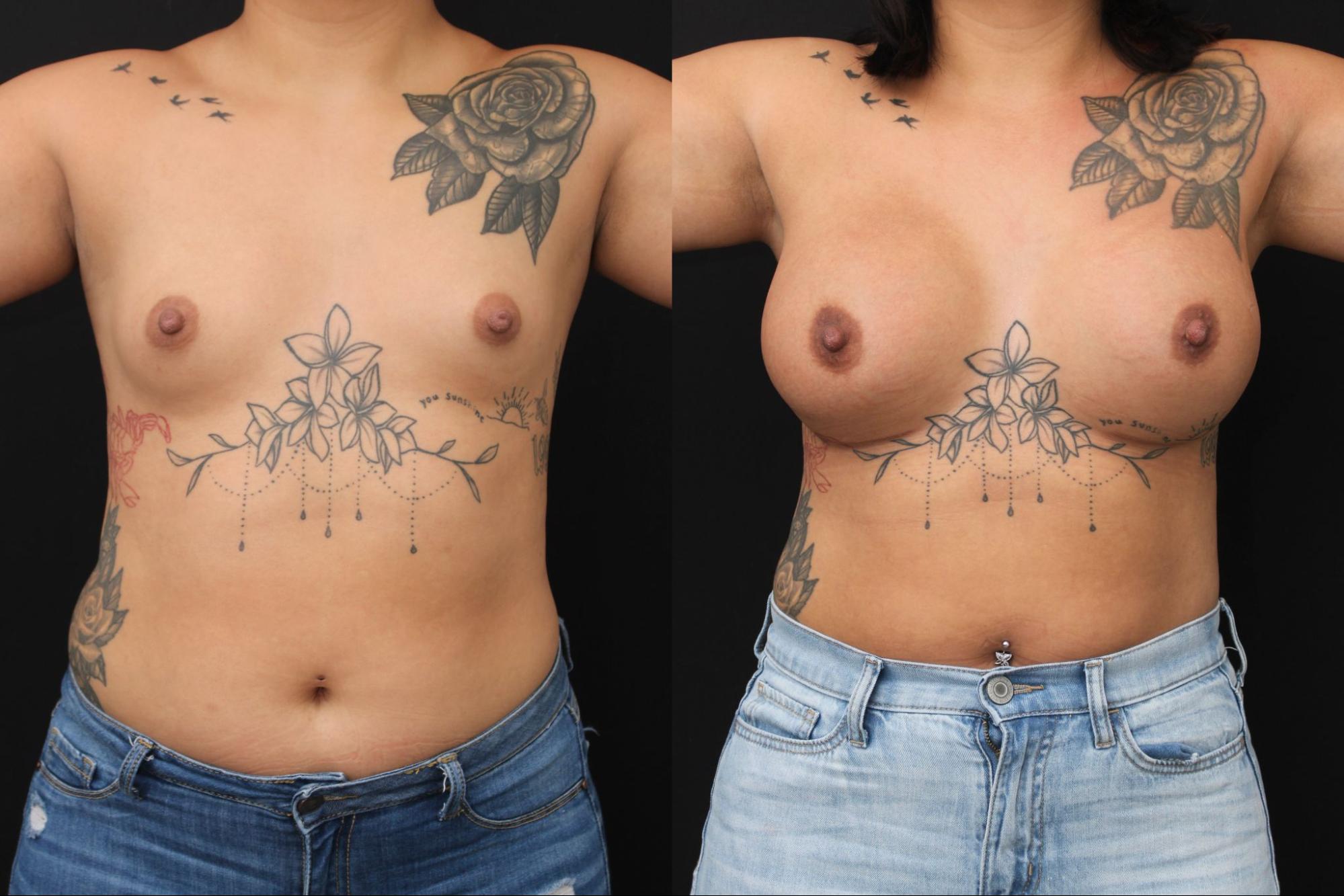 Breast Augmentation