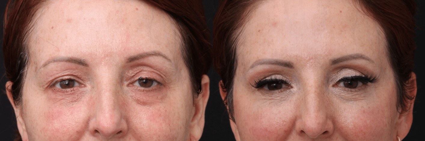 Blepharoplasty Eye lid lift