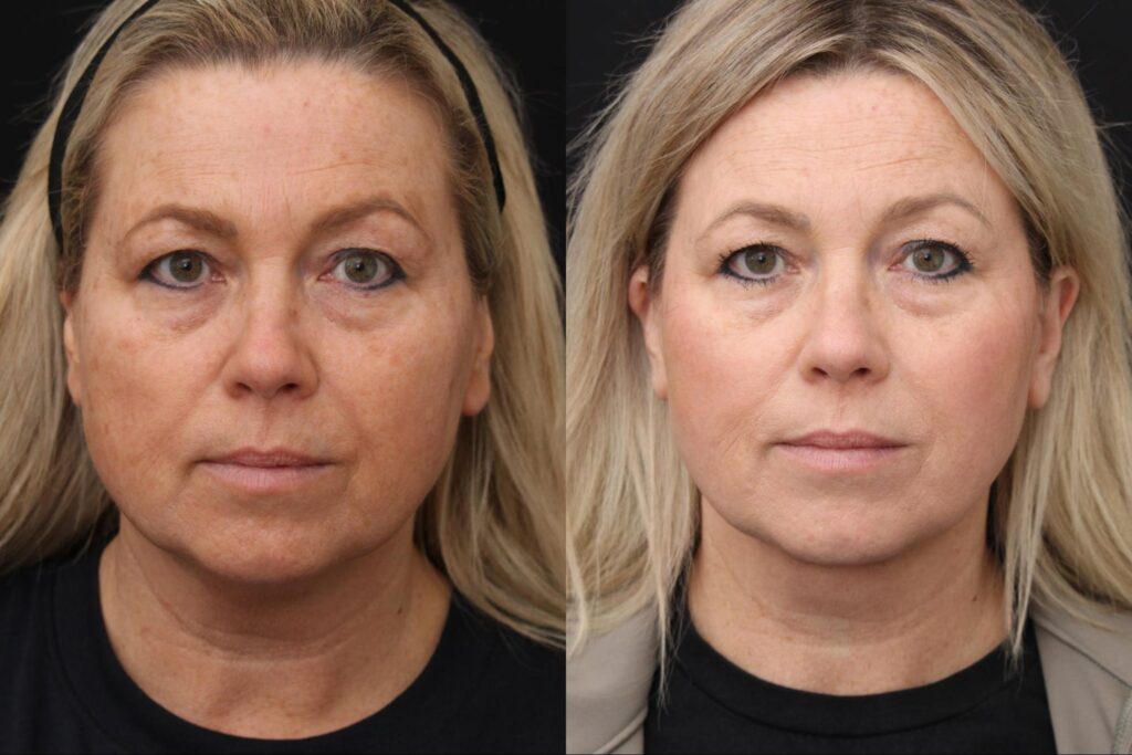 Face and Neck Lift